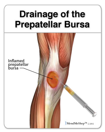 What kind of doctor treats bursitis of the knee?