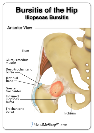 How do you treat hip pain associated with bursitis?